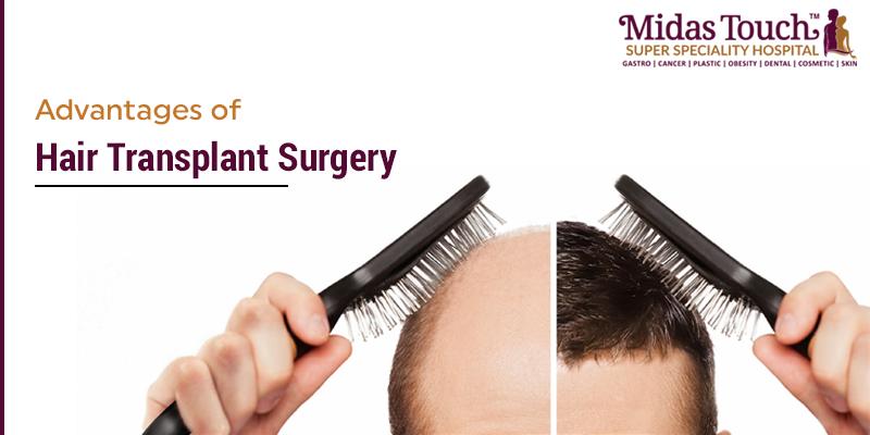 Advantages of Hair Transplant Surgery