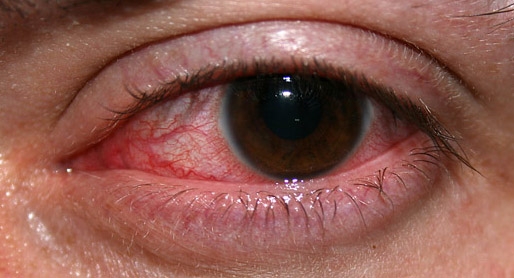 Snow Blindness: It's Symptoms, Causes & Prevention