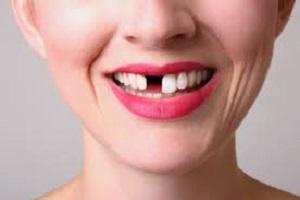 Fill the gap between your teeth with dental bridge