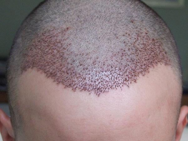 How to Minimize Potential Hair Transplantation Complications