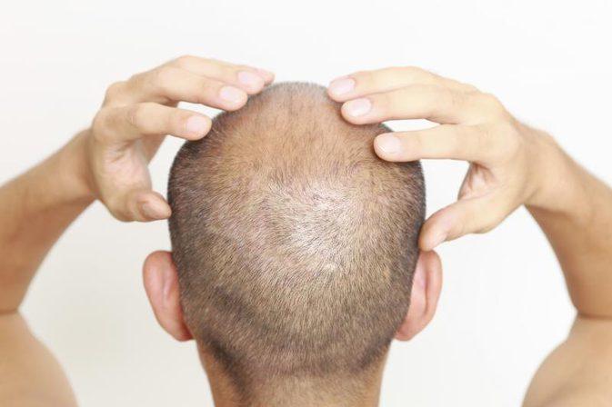 Should You Start Massaging Scalp After Hair Transplant?