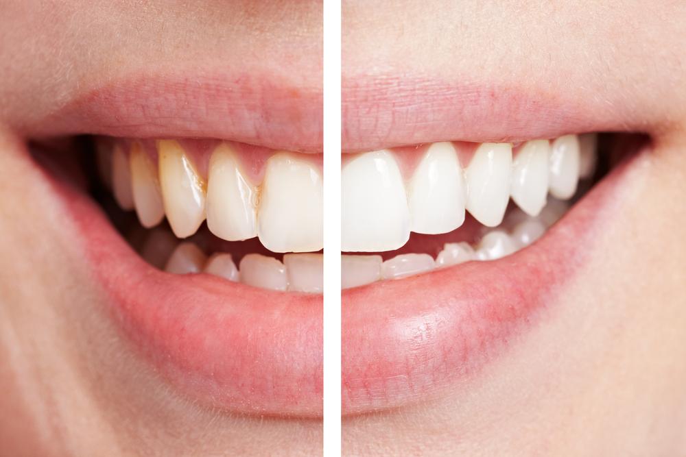 Have Bright and Shinier Smile With Teeth Whitening Services