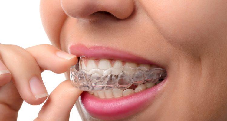 Everything You Need to Know About Invisalign