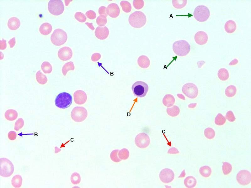 What are the causes of hemolytic anemia?