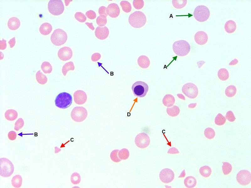 What are the causes of hemolytic anemia?