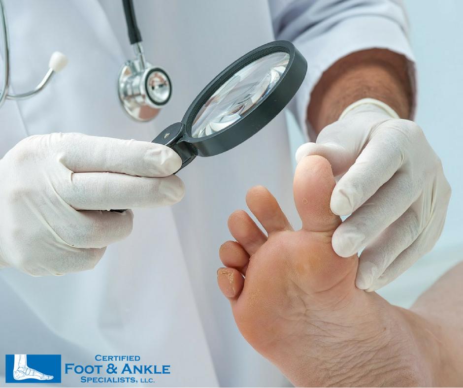 Why Diabetic Foot Care is so Important