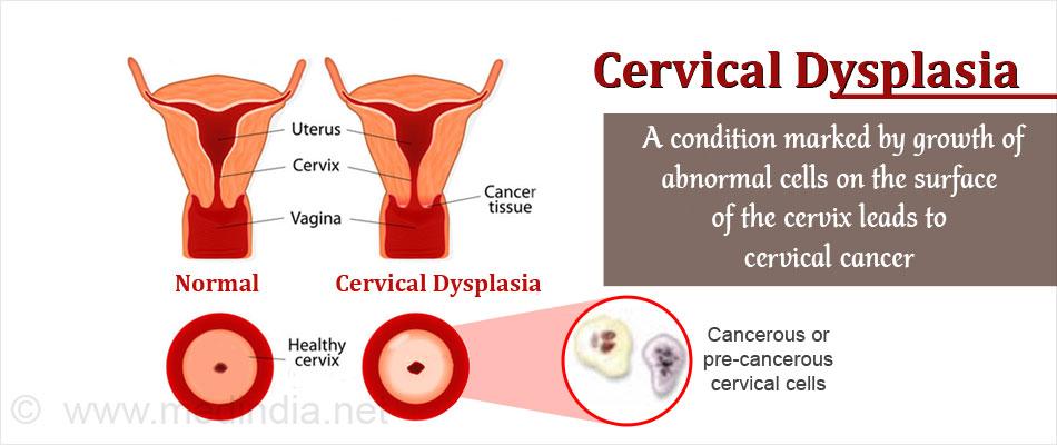 Detailed Analysis on Global Cervical Dysplasia Market