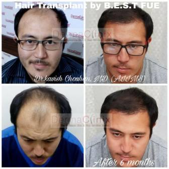 Does We Need Hair Transplantation Treatment?