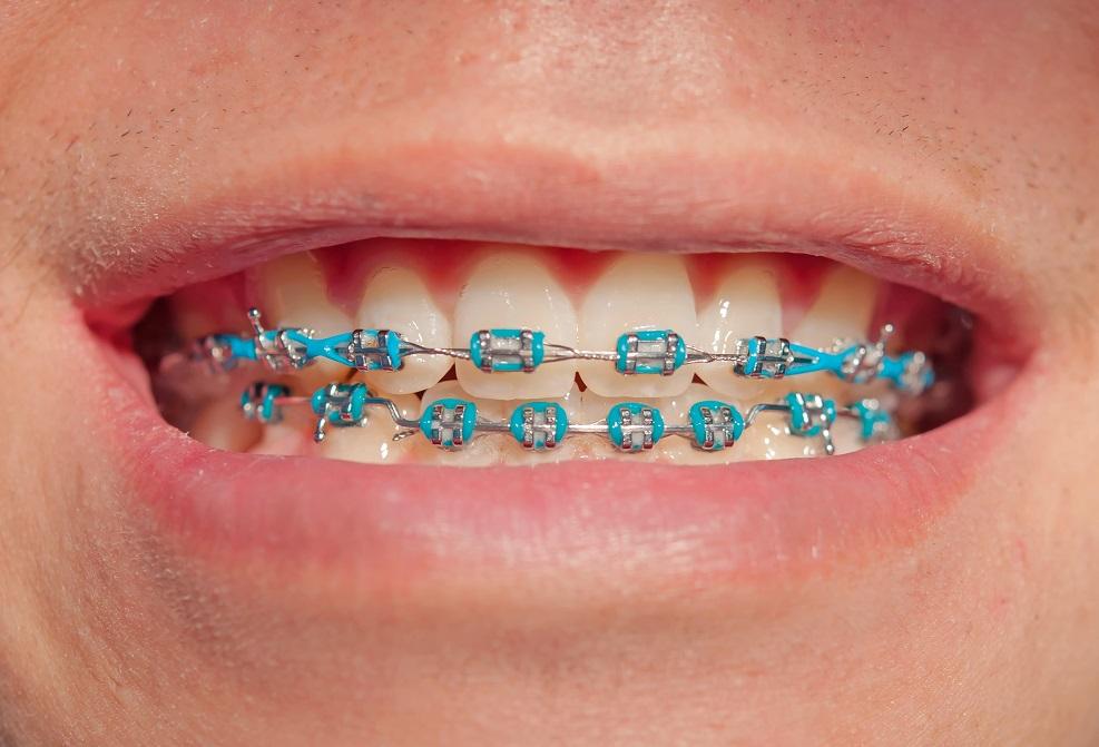 Why invisible braces are becoming popular for fixing dental alignment problems?