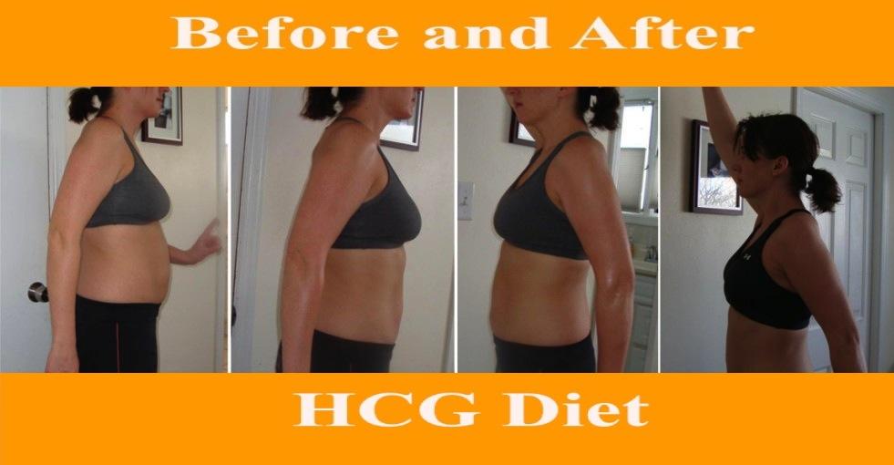 Is HCG Diet a Long-Term Solution for Obesity? 