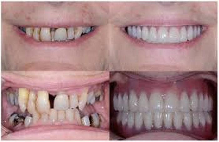 Why to replace your missing tooth  immediately?