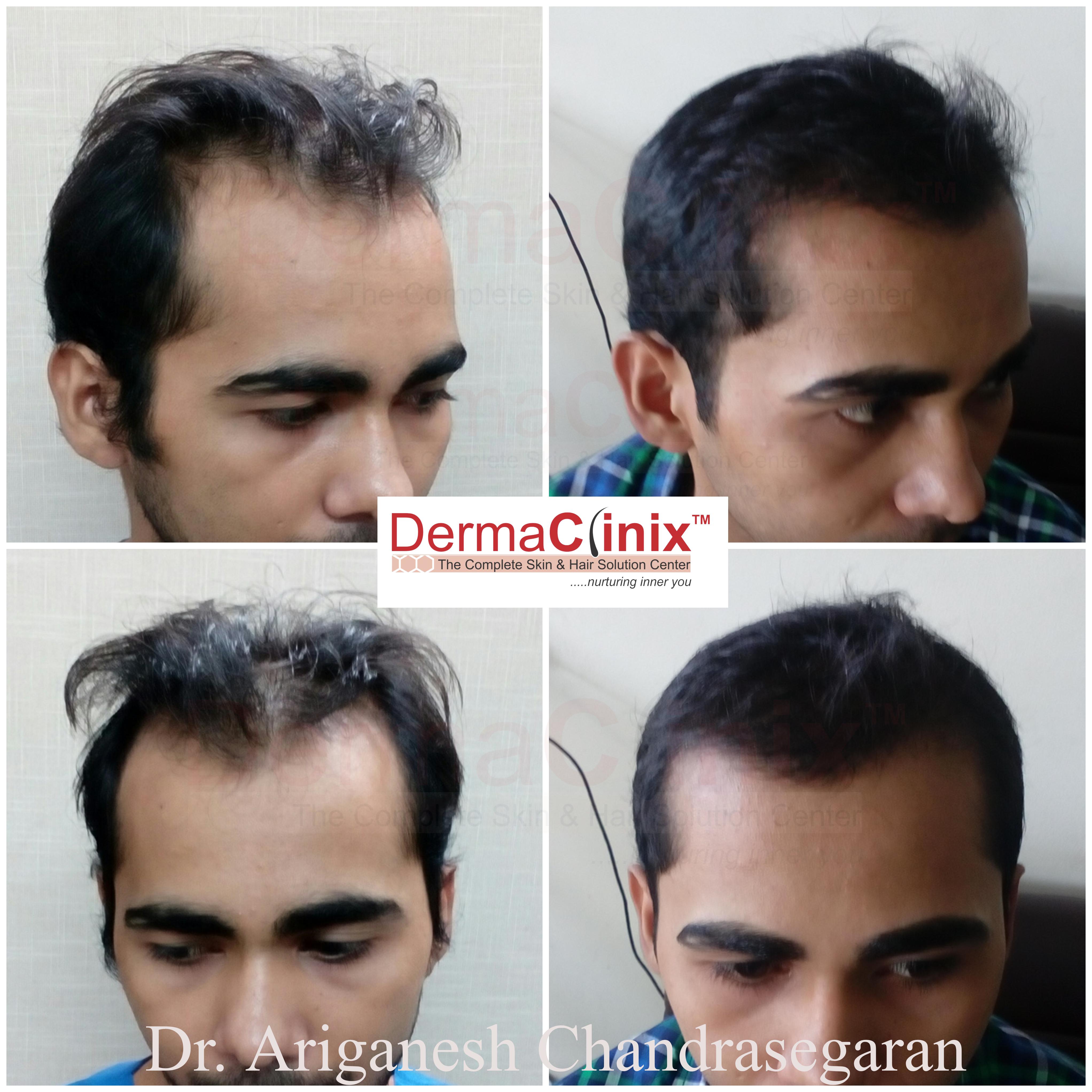 Number of Hair Transplantation One Can Get in a Lifetime