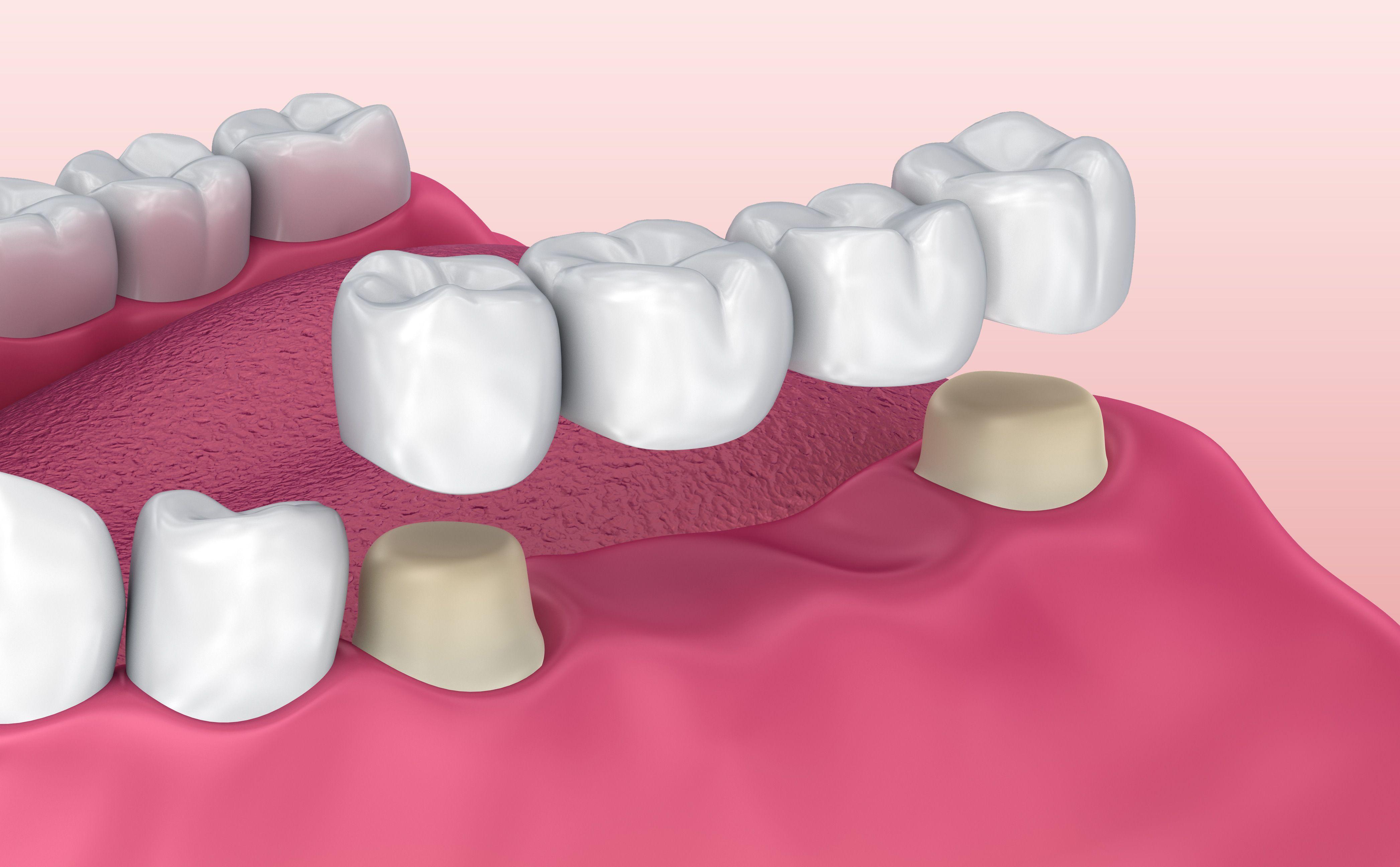 What Are The Three Main Types Of Dental Bridges?