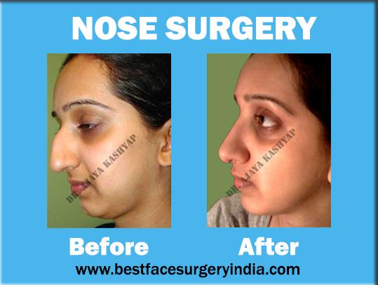 Rhinoplasty: Get a Perfect Shaped Nose Now!