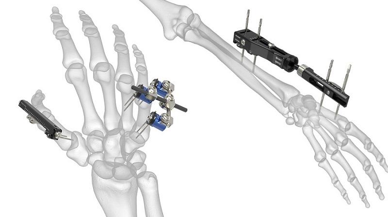 Orthopedic Surgical Procedures Used for Bone Fixation 