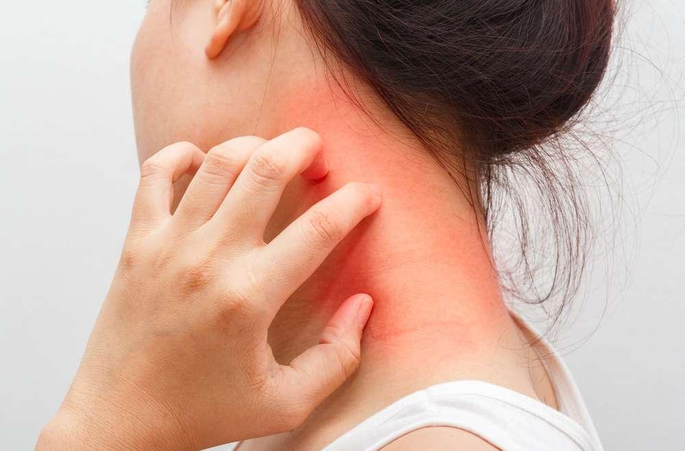 Want to get rid of Eczema? Well, here are some tricks and tips to help you