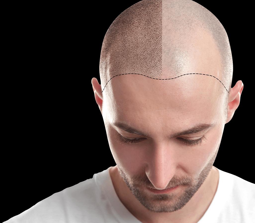 Things To Do In Order To Prevent Hair Loss