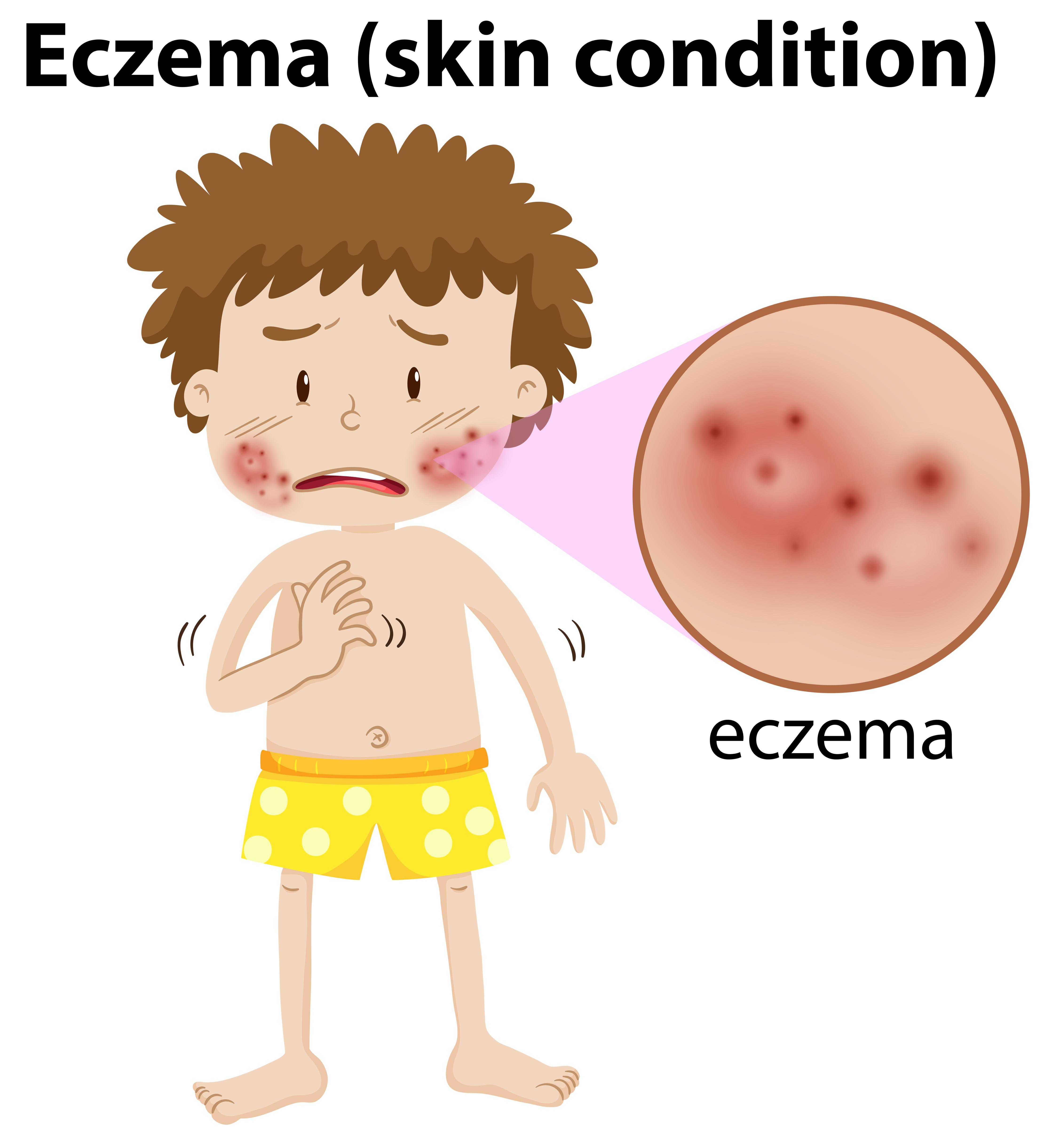 Causes and Symptoms of Dermatitis and How to Contact for Treatment Online