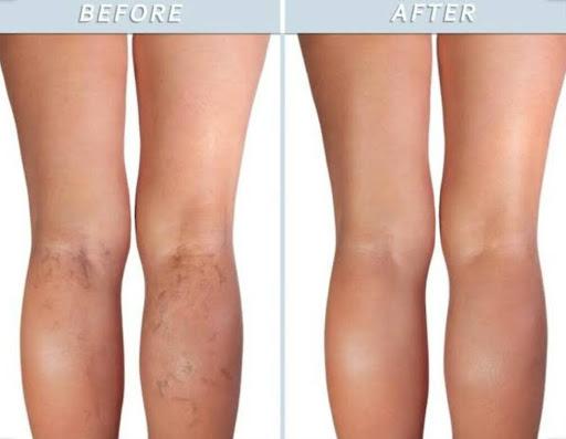 Effective ways to get rid of spider veins on legs