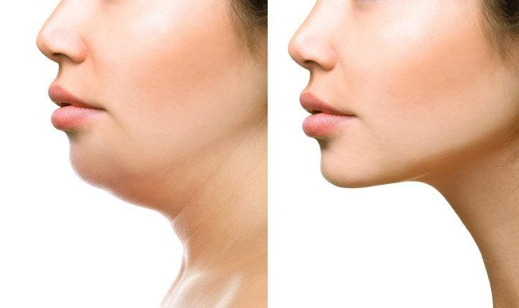 Ten reasons you should try Kybella treatment