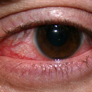 Snow Blindness: It's Symptoms, Causes & Prevention