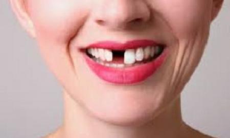 Fill the gap between your teeth with dental bridge