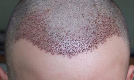 How to Minimize Potential Hair Transplantation Complications