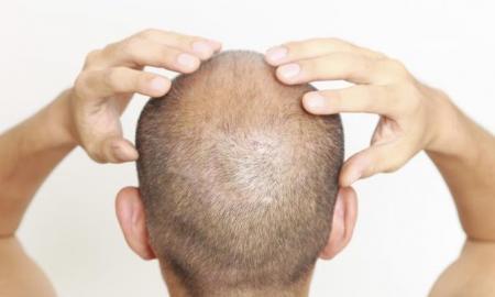 Should You Start Massaging Scalp After Hair Transplant?