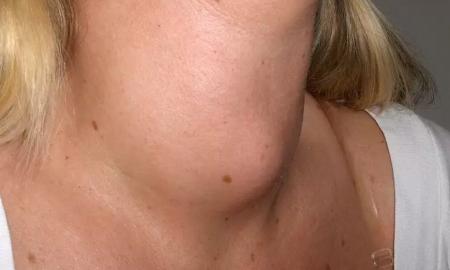 Is It Necessary To Design A Healthy Graves’ Disease Diet?