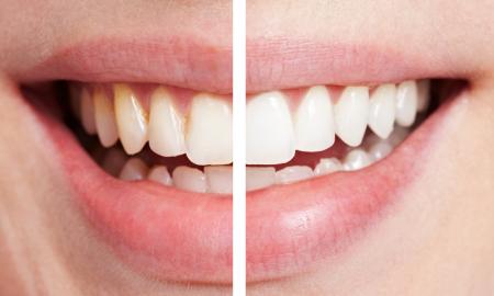 Have Bright and Shinier Smile With Teeth Whitening Services