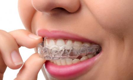 Everything You Need to Know About Invisalign