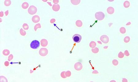 What are the causes of hemolytic anemia?