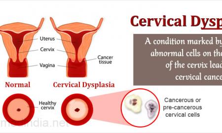 Detailed Analysis on Global Cervical Dysplasia Market