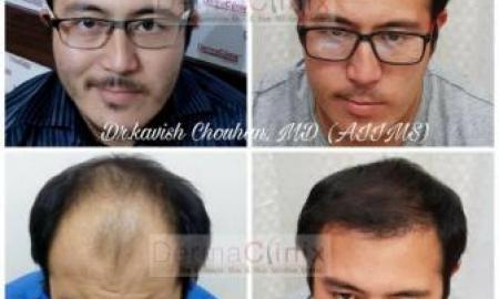Does We Need Hair Transplantation Treatment?