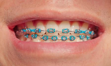 Why invisible braces are becoming popular for fixing dental alignment problems?