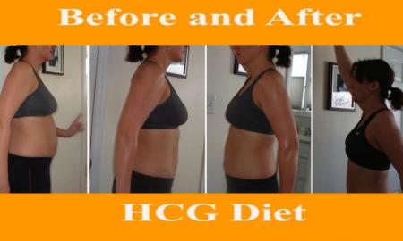 Is HCG Diet a Long-Term Solution for Obesity? 