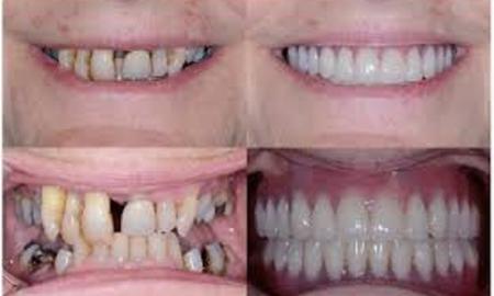 Why to replace your missing tooth  immediately?