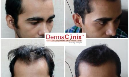 Number of Hair Transplantation One Can Get in a Lifetime