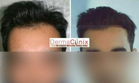 Things Which You Need to Consider About Before Hair Restoration Treatment