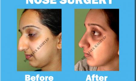 Rhinoplasty: Get a Perfect Shaped Nose Now!
