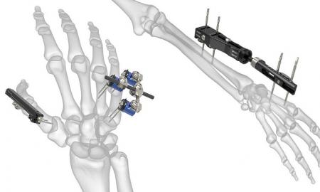 Orthopedic Surgical Procedures Used for Bone Fixation 