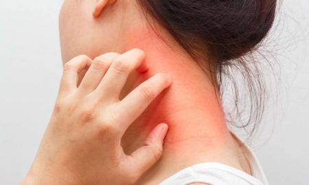 Want to get rid of Eczema? Well, here are some tricks and tips to help you