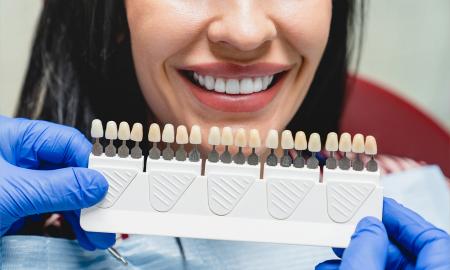 Here is What You Need to Know About Laminate Veneers