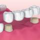 What Are The Three Main Types Of Dental Bridges?